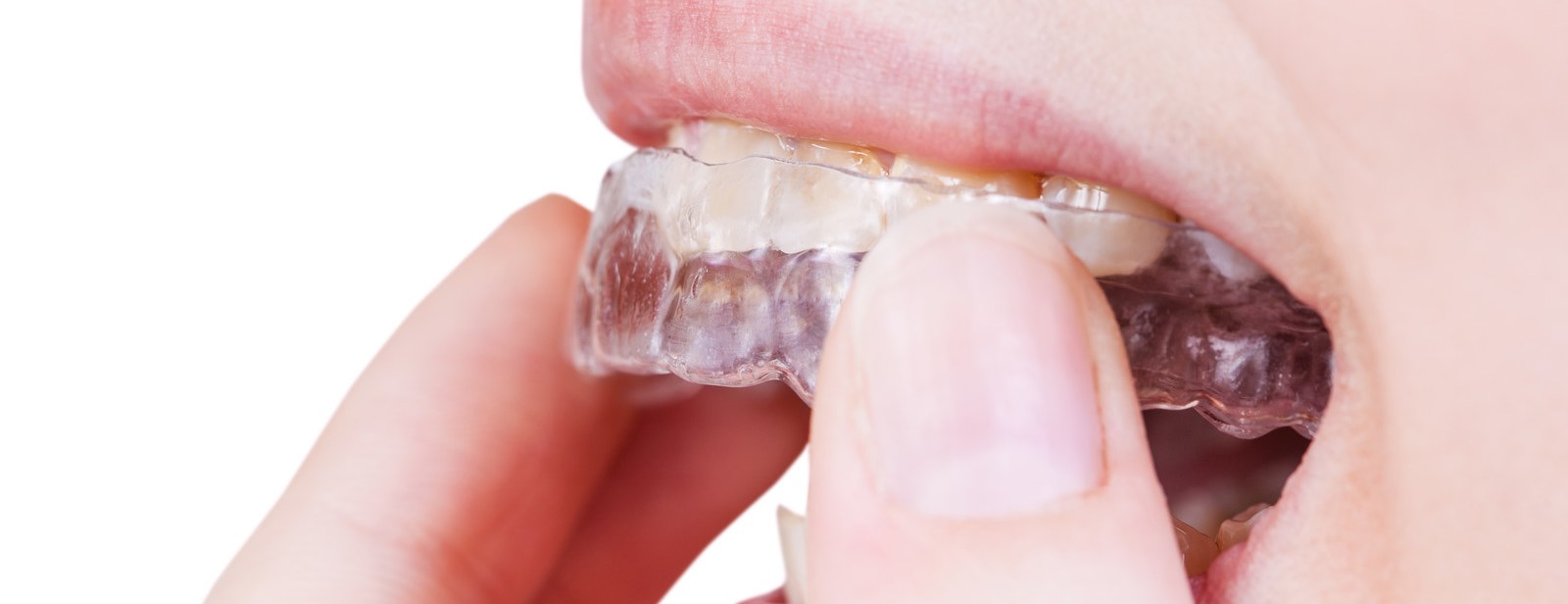 Ortodonzia Invisibile Centro Dentale Parmense | Dentisti in Parma: speciali mascherine dentali trasparenti rimovibili